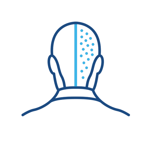 زراعة شعر الطبيعي